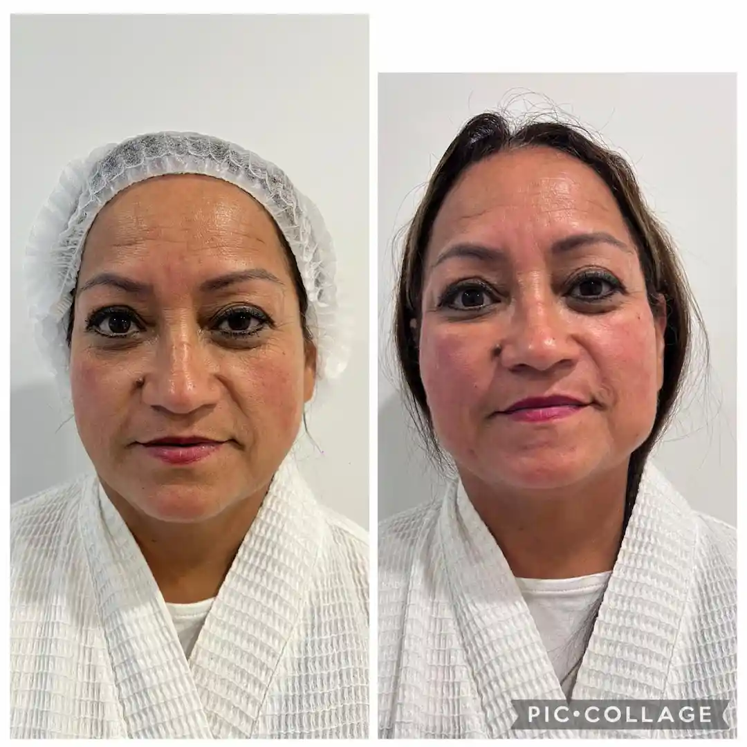 Antes y después de tratamiento con bioestimuladores — Valentina Castillo